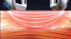 Laser SmartXide DOT tuyệt vời hơn phương pháp trị liệu thông thường như thế nào?