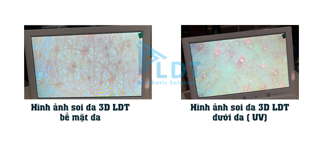 Hình ảnh chụp của máy soi da 3D LDT