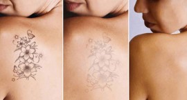 Công nghệ xoá xăm 2022 