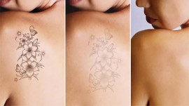 Bật Mí Cách Xóa Xăm Không Để Lại Sẹo